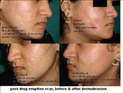 Before After Pictures,Cosmetic surgery,Delhi,face 1 dermabrasion, scar face